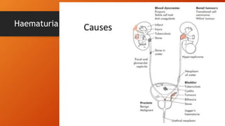 Haematuria
 