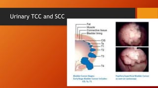 Urinary TCC and SCC
 