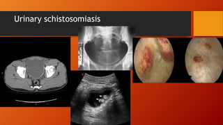 Urinary schistosomiasis
 