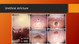 Urethral stricture
 