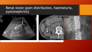 Renal stone (pain distribution, haematuria,
pyelonephritis)
 