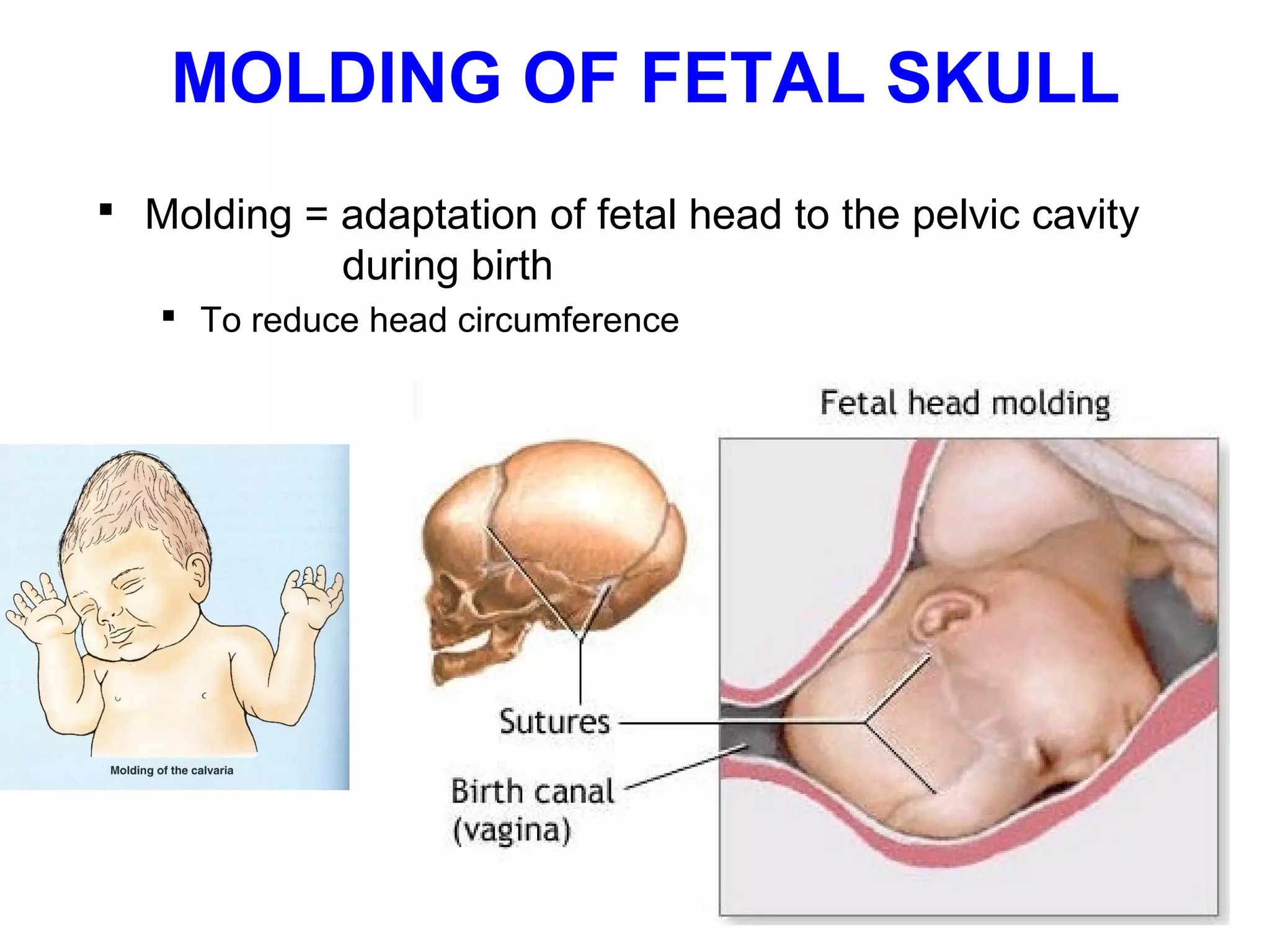 Positional Molding Applied anatomy of pelvis and fetal skull | PPT