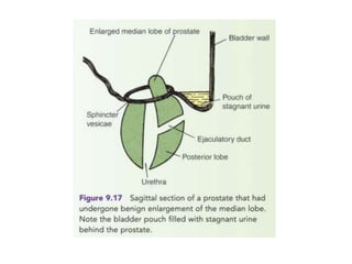 Applied anatomy of the prostate and seminal vesicles | PPTX