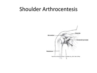 Shoulder Arthrocentesis
 