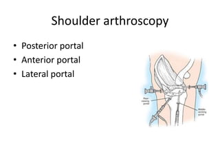 Shoulder arthroscopy
• Posterior portal
• Anterior portal
• Lateral portal
 