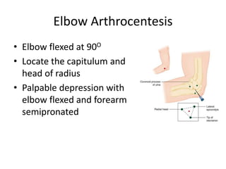 Elbow Arthrocentesis
• Elbow flexed at 90O
• Locate the capitulum and
head of radius
• Palpable depression with
elbow flexed and forearm
semipronated
 