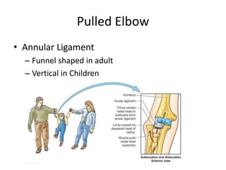Pulled Elbow
• Annular Ligament
– Funnel shaped in adult
– Vertical in Children
 