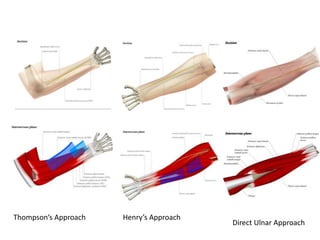 • THomsp
Thompson’s Approach Henry’s Approach
Direct Ulnar Approach
 