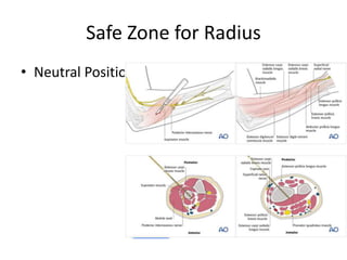 Safe Zone for Radius
• Neutral Position
 