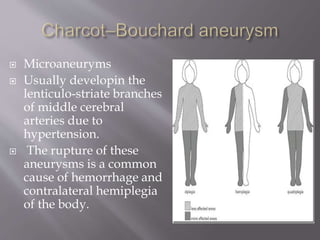  Microaneuryms
 Usually developin the
lenticulo-striate branches
of middle cerebral
arteries due to
hypertension.
 The rupture of these
aneurysms is a common
cause of hemorrhage and
contralateral hemiplegia
of the body.
 