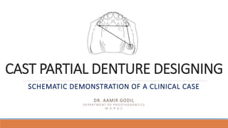 CAST PARTIAL DENTURE DESIGNING
DR. AAMIR GODIL
DEPARTMENT OF PROSTHODONTICS
M. A .R.D.C
SCHEMATIC DEMONSTRATION OF A CLINICAL CASE
 