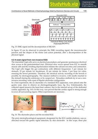 Contributions to Novel Methods in Electrophysiology Aided by Electronic Devices and Circuits 135
Fig. 15. EMG signal and the decomposition of MUAPs
In figure 15 can be observed in principle the EMG recording signal, the neuromuscular
junction and the shapes of the motor unit action potential, after a decomposition of the
physical signal.
4.2 A weak signal from non-invasive EGG
The interstitial Cajal cells serve as electrical pacemakers and generate spontaneous electrical
slow waves in the gastrointestinal tract. Electrical slow waves spread from ICC to smooth
muscle cells and the resulting depolarization initiates the calcium ion entry and contraction.
The Cajal cells trigger the gut contractions with different frequencies: 3 per minute for
stomach, 12 per minute for duodenum, 10 per minute for ileum, 3 per hour for colon,
ensuring the bowel peristalsis. Therefore, the electrical activity recording of the bowels is
possible, by electrogastrography. The classical method is invasive, with needle inserted in
the stomach during the endoscopy or by surgical act. Nowadays methods try to use a non-
invasive recording, with a pair of bipolar electrodes configuration.
In a first experiment, the six electrodes of a standard ECG apparatus, were placed onto the
gastric zone, since to observe an electrogastrography trace, fig. 16.a. Unfortunately, the
collected signal preserve the heart beat cadence, due to the internal set-up of the dedicated
cardiac apparatus, fig. 16.b. In this way, was proved that the cardiac signal is strong enough
to cover all surrounding organs. Other experiments are necessary.
(a) (b) (c)
Fig. 16. The electrodes places and the recorded EGG
The prior electrophysiological equipment, designated for the ECG mobile platform, was re-
allocated toward the gastric signal detection, by skin electrodes. In this scope, three plat
 