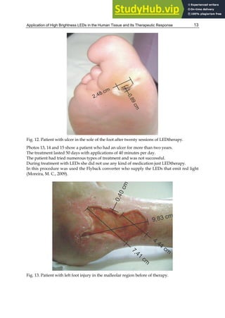 Application of High Brightness LEDs in the Human Tissue and Its Therapeutic Response 13
Fig. 12. Patient with ulcer in the sole of the foot after twenty sessions of LEDtherapy.
Photos 13, 14 and 15 show a patient who had an ulcer for more than two years.
The treatment lasted 50 days with applications of 40 minutes per day.
The patient had tried numerous types of treatment and was not successful.
During treatment with LEDs she did not use any kind of medication just LEDtherapy.
In this procedure was used the Flyback converter who supply the LEDs that emit red light
(Moreira, M. C., 2009).
Fig. 13. Patient with left foot injury in the malleolar region before of therapy.
 