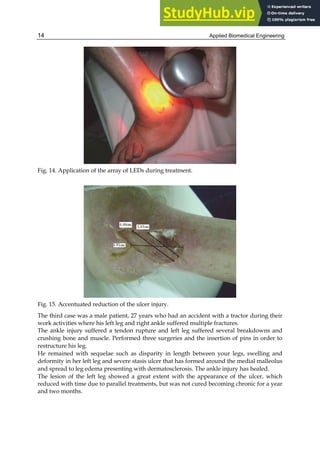 Applied Biomedical Engineering
14
Fig. 14. Application of the array of LEDs during treatment.
Fig. 15. Accentuated reduction of the ulcer injury.
The third case was a male patient, 27 years who had an accident with a tractor during their
work activities where his left leg and right ankle suffered multiple fractures.
The ankle injury suffered a tendon rupture and left leg suffered several breakdowns and
crushing bone and muscle. Performed three surgeries and the insertion of pins in order to
restructure his leg.
He remained with sequelae such as disparity in length between your legs, swelling and
deformity in her left leg and severe stasis ulcer that has formed around the medial malleolus
and spread to leg edema presenting with dermatosclerosis. The ankle injury has healed.
The lesion of the left leg showed a great extent with the appearance of the ulcer, which
reduced with time due to parallel treatments, but was not cured becoming chronic for a year
and two months.
 