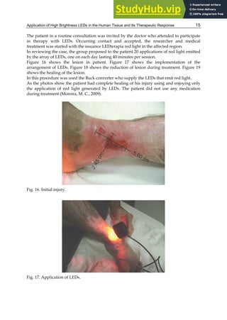 Application of High Brightness LEDs in the Human Tissue and Its Therapeutic Response 15
The patient in a routine consultation was invited by the doctor who attended to participate
in therapy with LEDs. Occurring contact and accepted, the researcher and medical
treatment was started with the issuance LEDterapia red light in the affected region.
In reviewing the case, the group proposed to the patient 20 applications of red light emitted
by the array of LEDs, one on each day lasting 40 minutes per session.
Figure 16 shows the lesion in patient. Figure 17 shows the implementation of the
arrangement of LEDs. Figure 18 shows the reduction of lesion during treatment. Figure 19
shows the healing of the lesion.
In this procedure was used the Buck converter who supply the LEDs that emit red light.
As the photos show the patient had complete healing of his injury using and enjoying only
the application of red light generated by LEDs. The patient did not use any medication
during treatment (Moreira, M. C., 2009).
Fig. 16. Initial injury.
Fig. 17. Application of LEDs.
 