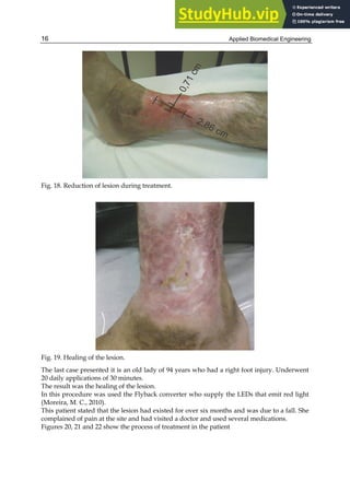 Applied Biomedical Engineering
16
Fig. 18. Reduction of lesion during treatment.
Fig. 19. Healing of the lesion.
The last case presented it is an old lady of 94 years who had a right foot injury. Underwent
20 daily applications of 30 minutes.
The result was the healing of the lesion.
In this procedure was used the Flyback converter who supply the LEDs that emit red light
(Moreira, M. C., 2010).
This patient stated that the lesion had existed for over six months and was due to a fall. She
complained of pain at the site and had visited a doctor and used several medications.
Figures 20, 21 and 22 show the process of treatment in the patient
 