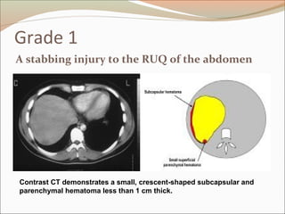 Grade 1
A stabbing injury to the RUQ of the abdomen
Contrast CT demonstrates a small, crescent-shaped subcapsular and
parenchymal hematoma less than 1 cm thick.
 