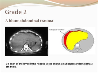 Grade 2
A blunt abdominal trauma
CT scan at the level of the hepatic veins shows a subcapsular hematoma 3
cm thick.
 