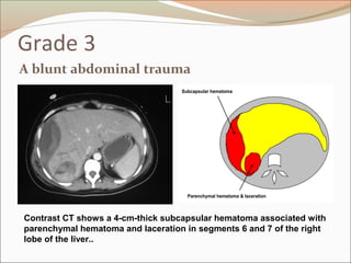Grade 3
A blunt abdominal trauma
Contrast CT shows a 4-cm-thick subcapsular hematoma associated with
parenchymal hematoma and laceration in segments 6 and 7 of the right
lobe of the liver..
 