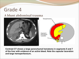 Grade 4
A blunt abdominal trauma
Contrast CT shows a large parenchymal hematoma in segments 6 and 7
of the liver with evidence of an active bleed. Note the capsular laceration
and large hemoperitoneum.
 