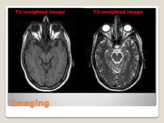 Imaging
T2-weighted imageT1-weighted image
 