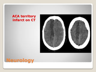 Neurology
ACA territory
infarct on CT
 