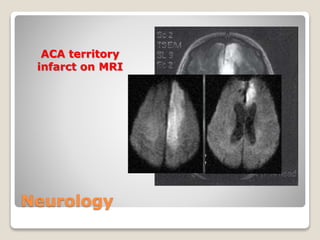 Neurology
ACA territory
infarct on MRI
 