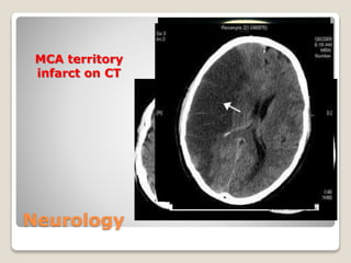 Neurology
MCA territory
infarct on CT
 