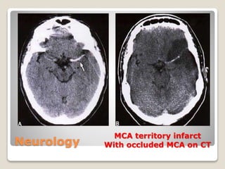 Neurology
MCA territory infarct
With occluded MCA on CT
 