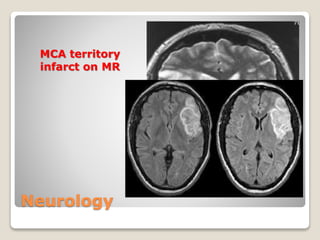 Neurology
MCA territory
infarct on MR
 