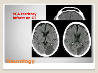 Neurology
PCA territory
infarct on CT
 