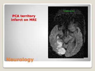 Neurology
PCA territory
infarct on MRI
 
