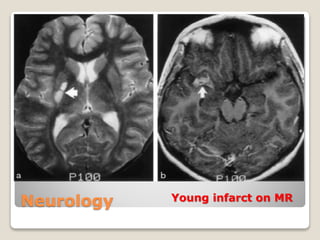 Neurology Young infarct on MR
 