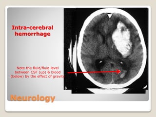 Neurology
Intra-cerebral
hemorrhage
Note the fluid/fluid level
between CSF (up) & blood
(below) by the effect of gravity
 