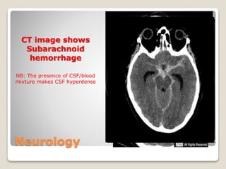 Neurology
CT image shows
Subarachnoid
hemorrhage
NB: The presence of CSF/blood
mixture makes CSF hyperdense
 