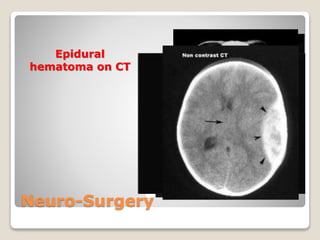 Neuro-Surgery
Epidural
hematoma on CT
 