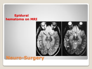 Neuro-Surgery
Epidural
hematoma on MRI
 
