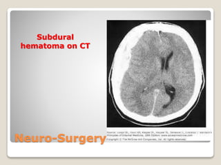 Neuro-Surgery
Subdural
hematoma on CT
 