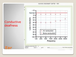 Ear
Conductive
deafness
 