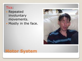 Motor System
Tics:
 Repeated
involuntary
movements.
 Mostly in the face.
 