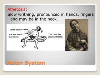Motor System
Athetosis:
Slow writhing, pronounced in hands, fingers
and may be in the neck.
 