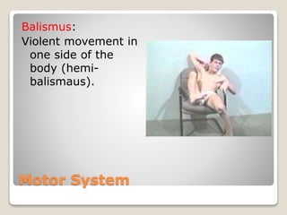 Motor System
Balismus:
Violent movement in
one side of the
body (hemi-
balismaus).
 