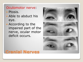 Cranial Nerves
Oculomotor nerve:
 Ptosis.
 Able to abduct his
eye.
 According to the
impaired part of the
nerve, ocular motor
deficit occurs.
 