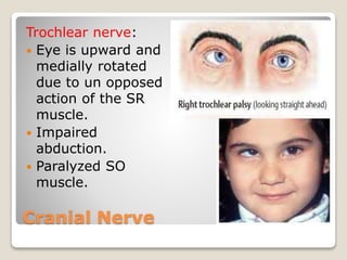 Cranial Nerve
Trochlear nerve:
 Eye is upward and
medially rotated
due to un opposed
action of the SR
muscle.
 Impaired
abduction.
 Paralyzed SO
muscle.
 