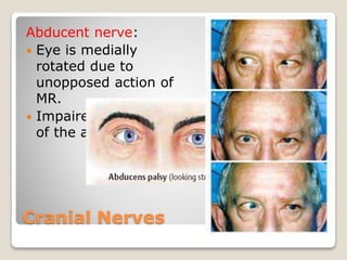 Cranial Nerves
Abducent nerve:
 Eye is medially
rotated due to
unopposed action of
MR.
 Impaired abduction
of the affected eye.
 