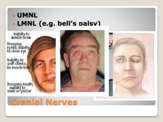 Cranial Nerves
 UMNL
 LMNL (e.g. bell’s palsy)
 