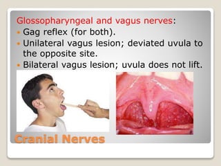 Cranial Nerves
Glossopharyngeal and vagus nerves:
 Gag reflex (for both).
 Unilateral vagus lesion; deviated uvula to
the opposite site.
 Bilateral vagus lesion; uvula does not lift.
 