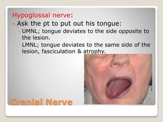 Cranial Nerve
Hypoglossal nerve:
 Ask the pt to put out his tongue:
◦ UMNL; tongue deviates to the side opposite to
the lesion.
◦ LMNL; tongue deviates to the same side of the
lesion, fasciculation & atrophy.
 