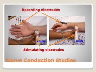 Nerve Conduction Studies
Recording electrodes
Stimulating electrodes
 