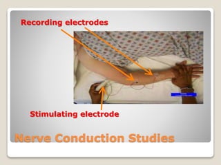Nerve Conduction Studies
Recording electrodes
Stimulating electrode
 